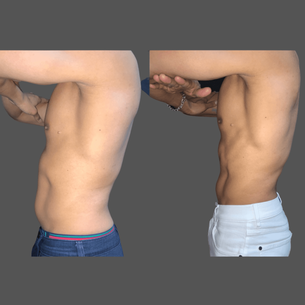 before and after body sculpting photo