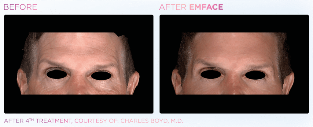emface before and after photo man