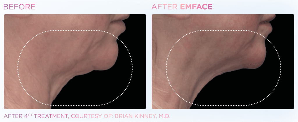 before and after emface 4th treatment result