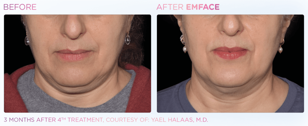 before and after emface three month result