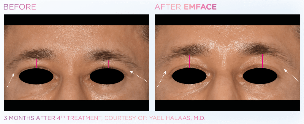 before and after emface three month result