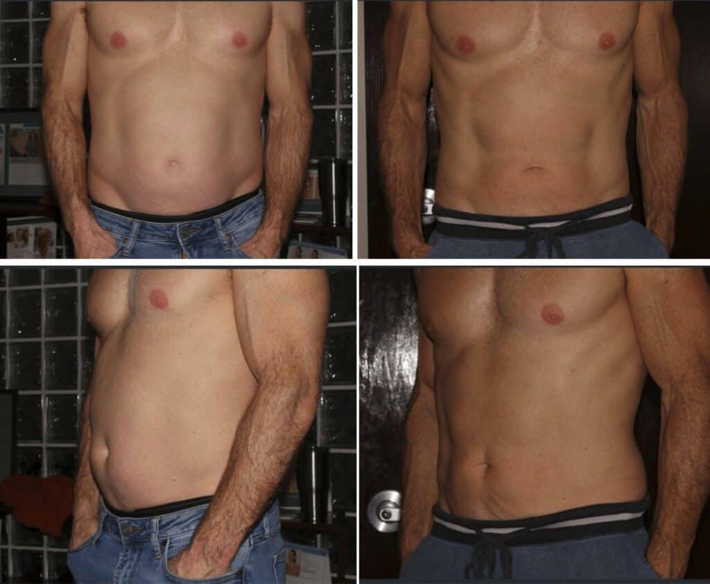 before and after emsculpt result on man