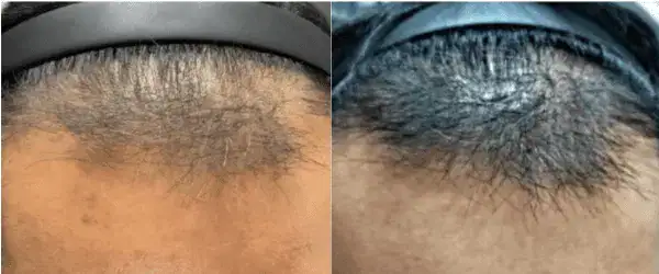 Hair Loss Treatment Kirkland