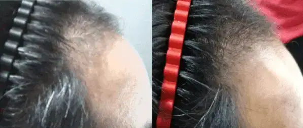 Hair Loss Treatment Seattle