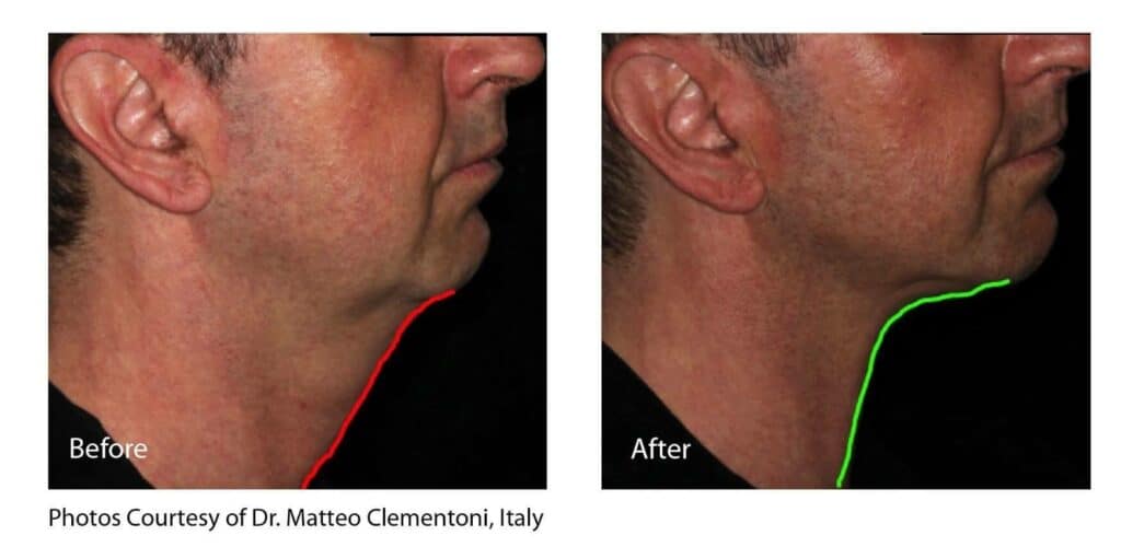 before and after double chin removal for men
