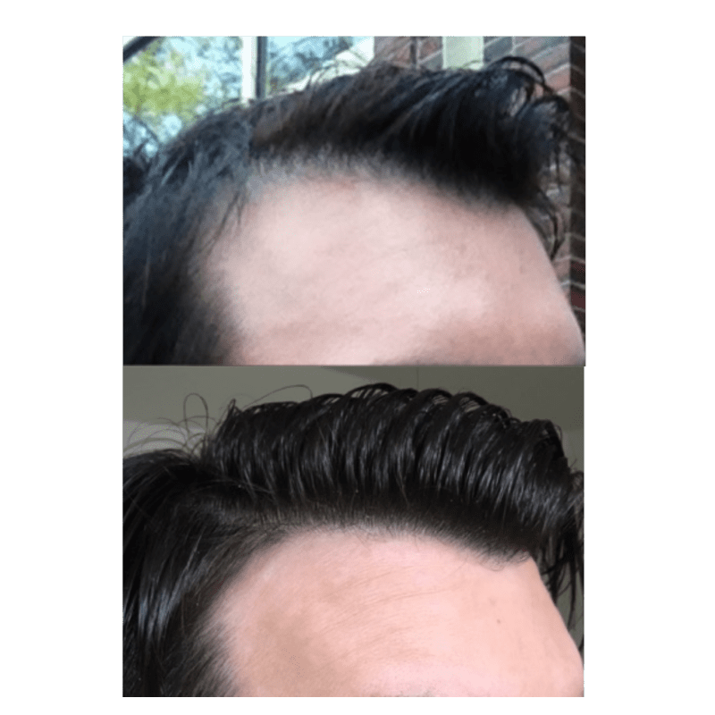 keralase before and after hair loss treatment
