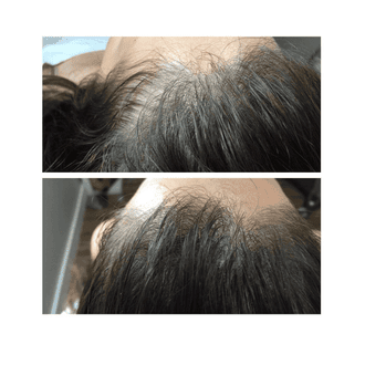 PRP Hair Loss Treatment Before after Kirkland