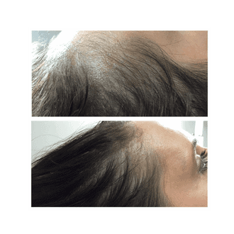 PRP Hair Loss Treatment Before after Seattle and Kirkland