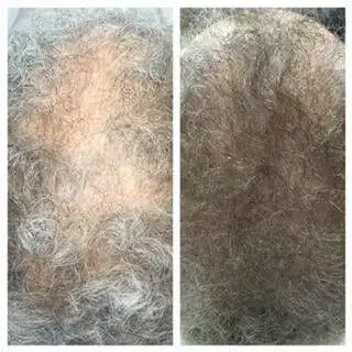 PRP Hair Loss Treatment Before after Seattle