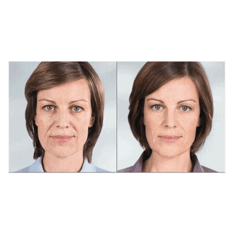 sculptra injections before and after