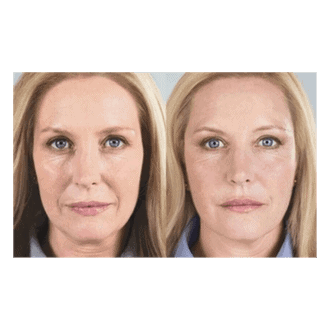 sculptra results before and after