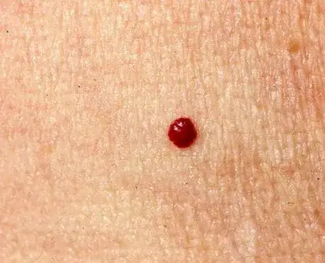 cherry hemangiomas