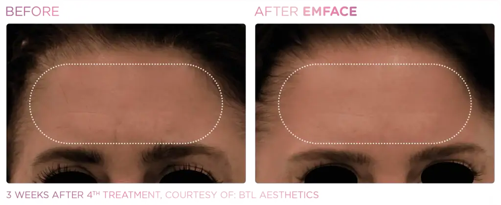 emface seattle Before and After