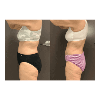 emsculpt neo Abdomen Kirkland