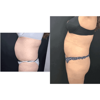 emsculpt neo Abdomen Seattle