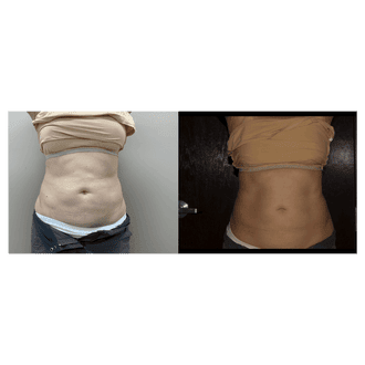 before and after Emsculpt NEO treatment Glow Medispa