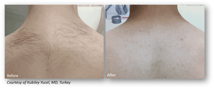 laser hair removal for men before and after photo