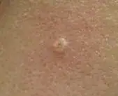 sebaceous hyperplasia